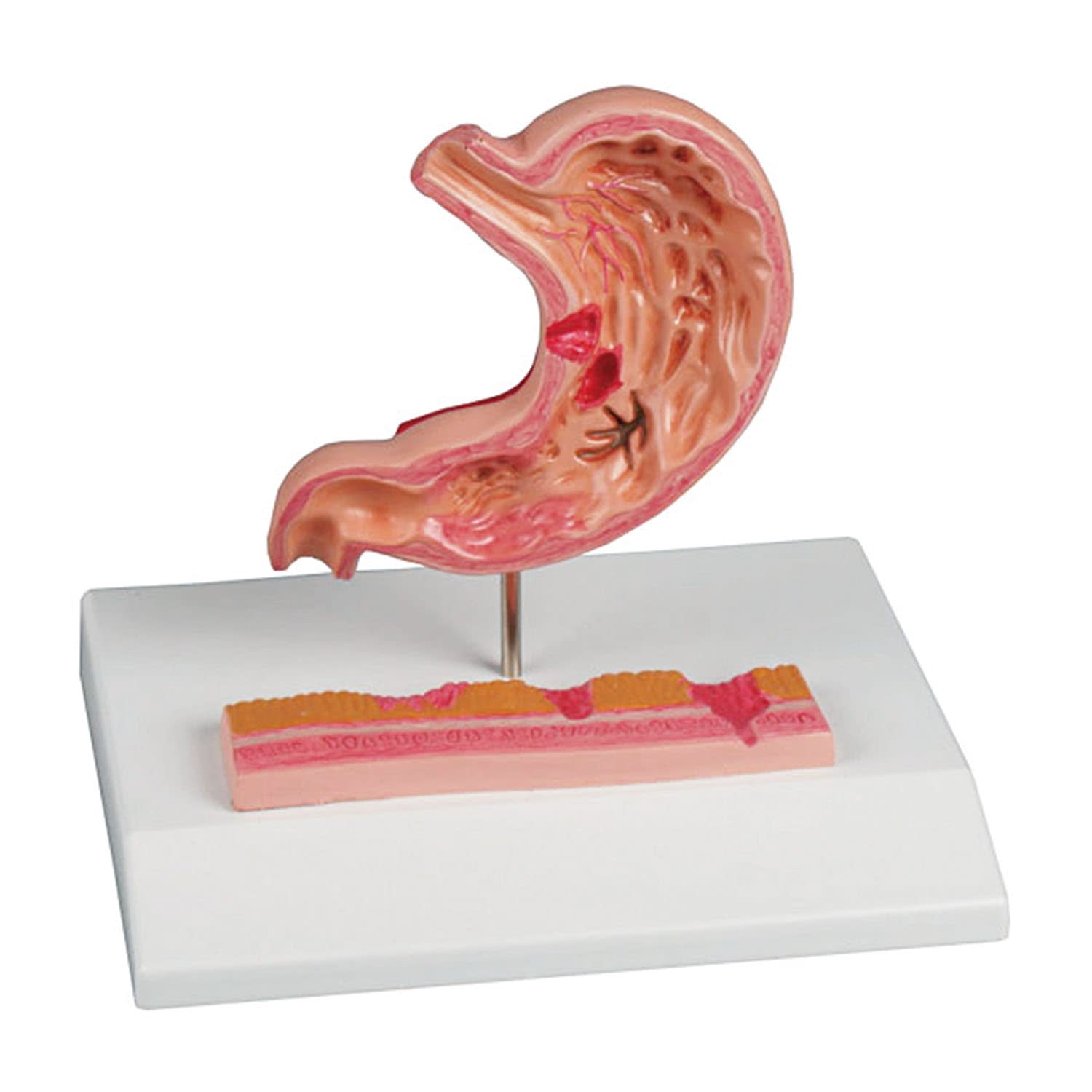 (24-5097-00)胃潰瘍モデル K217 ｲｶｲﾖｳﾓﾃﾞﾙ(エルラージーマー社)【1個単位】【2019年カタログ商品】